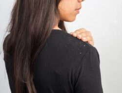 6 Bahan Alami Ampuh Atasi Ketombe dan Gatal Kulit Kepala